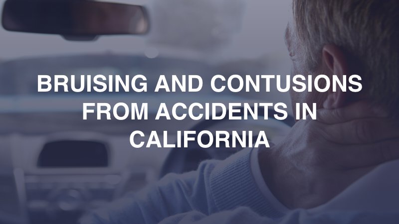 Bruising and Contusions from Accidents in California