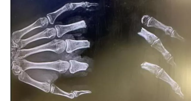 Teen who lost three fingers in jet ski incident sues Mission Bay Aquatic Center